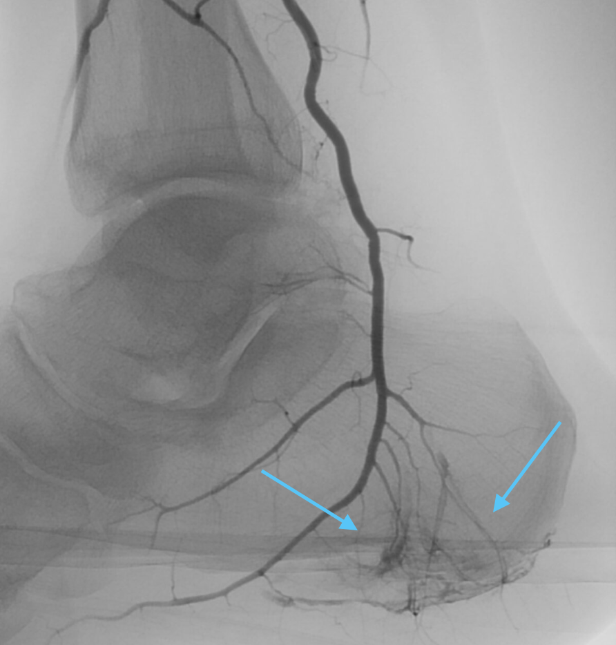 Plantar Fasciitis Angiogram 2b