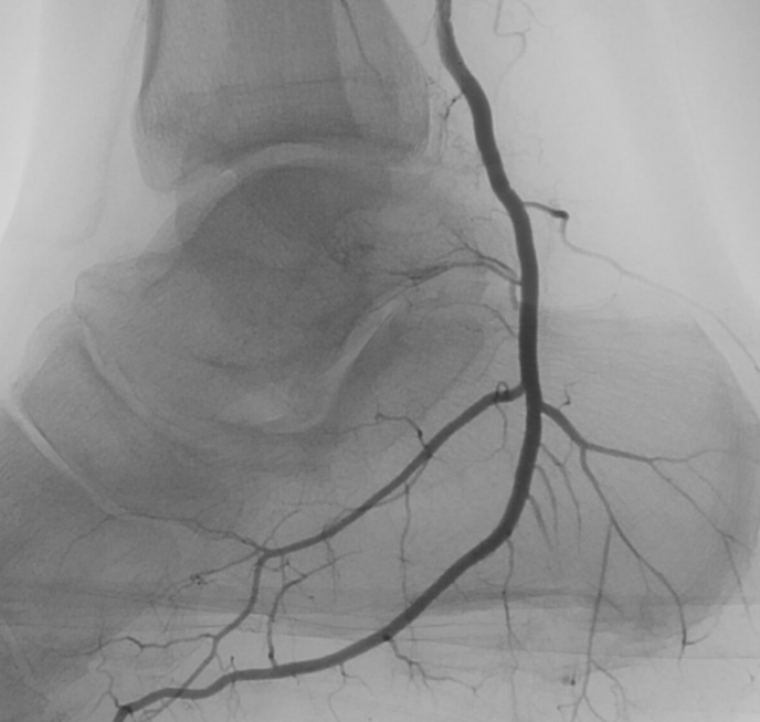 Plantar Fasciitis Angiogram after Embolization 3b