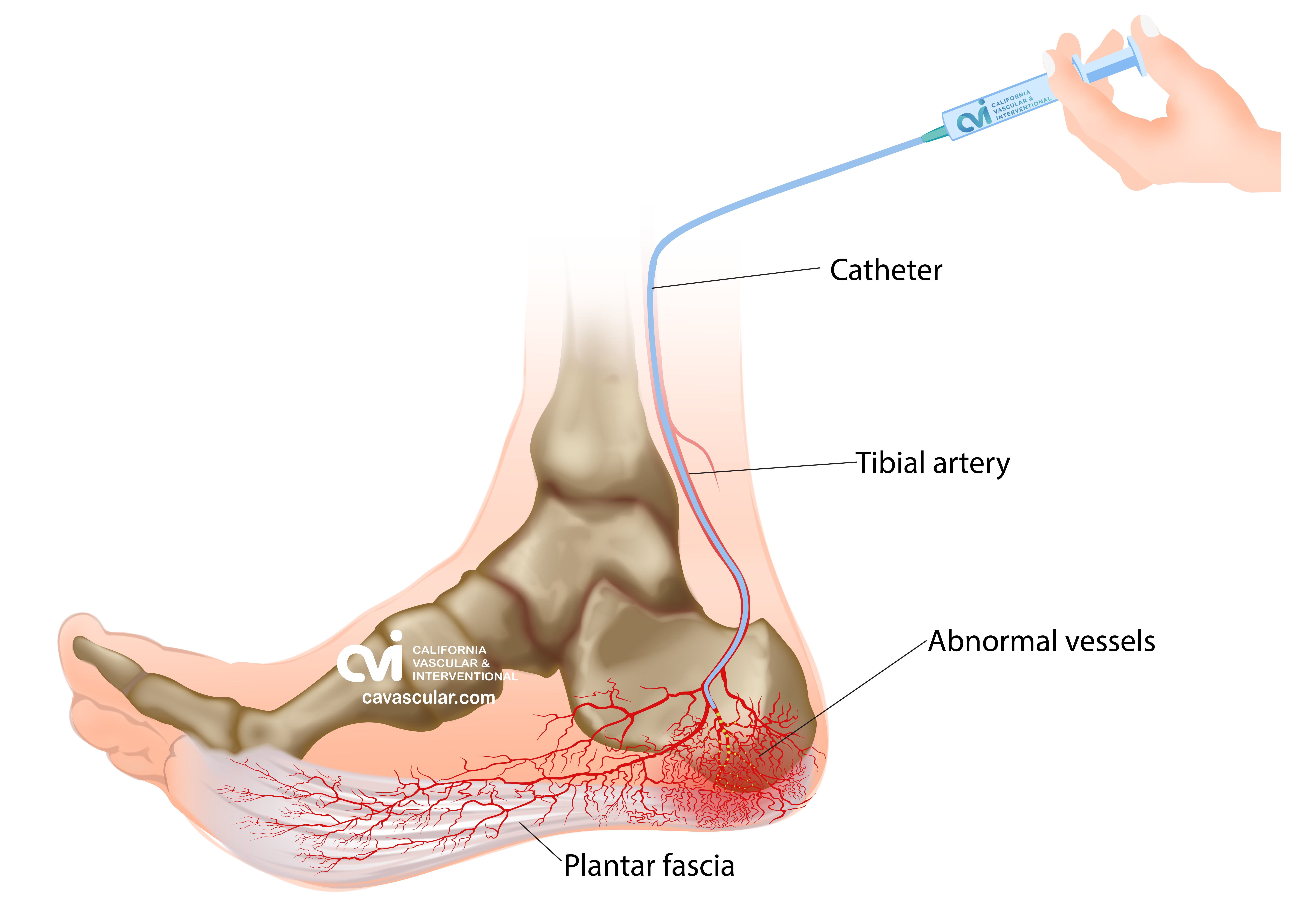 Plantar Fasciitis Embolization Treatment illustration