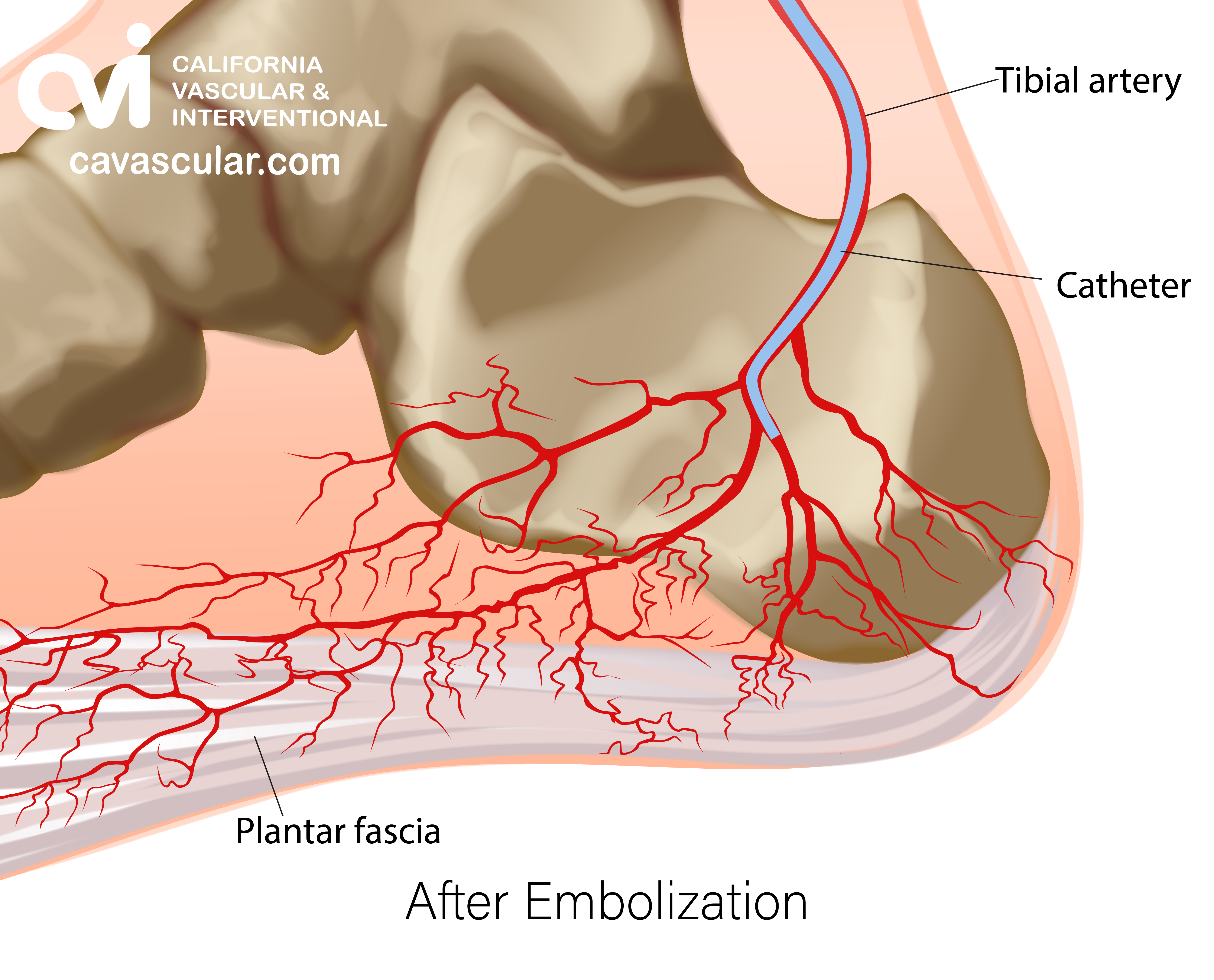 Plantar Fasciitis illustration after embolization 3a