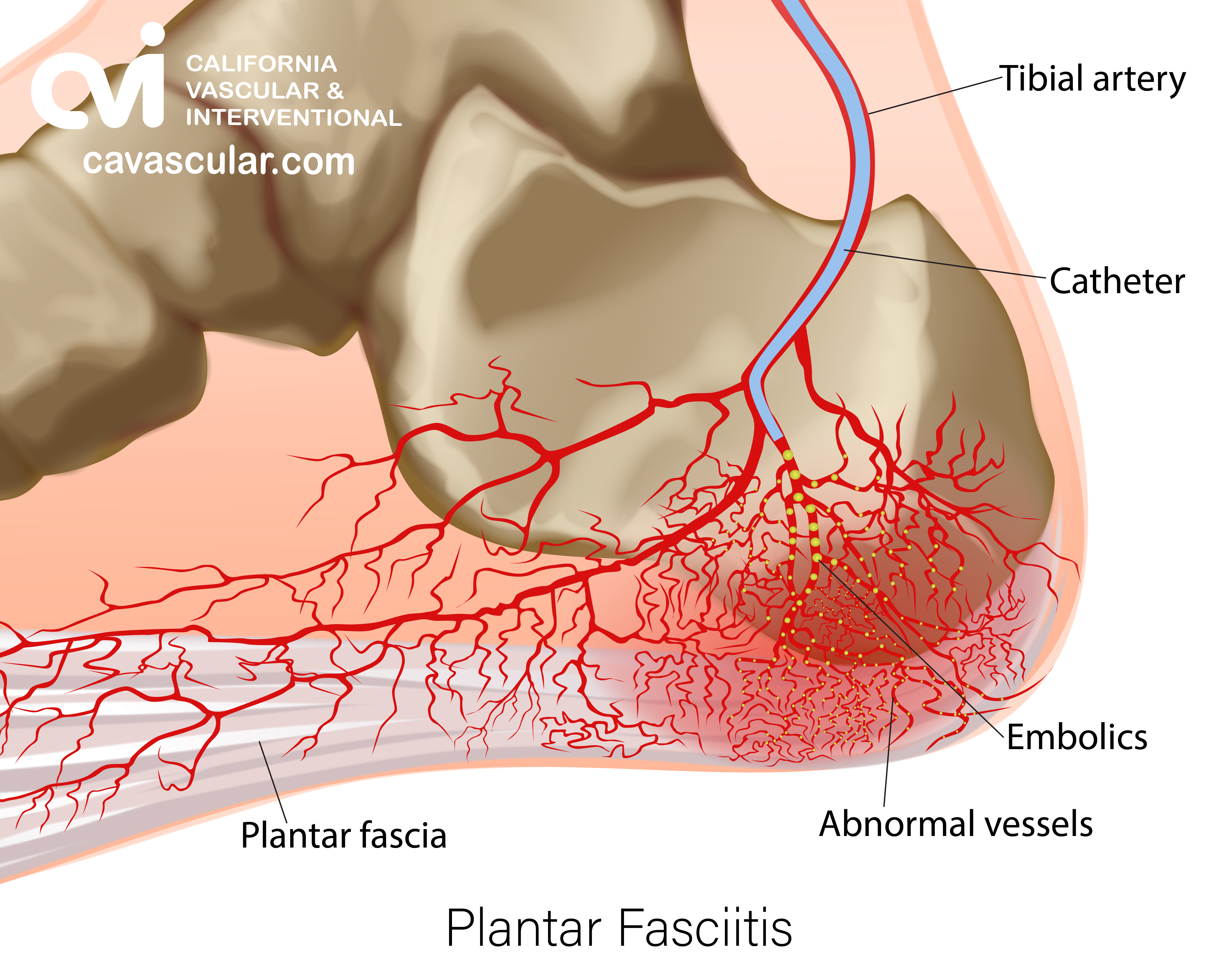 Plantar Fasciitis illustration vascular treatment 2a