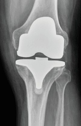 What is hemarthrosis