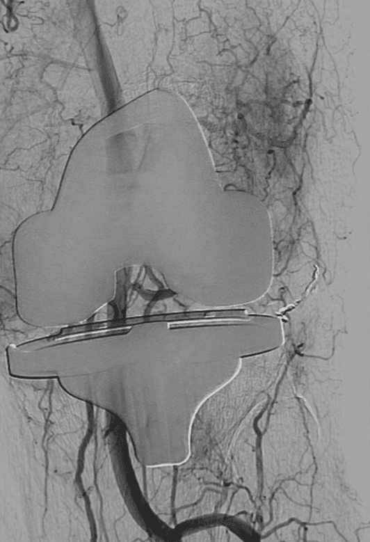 Treatment options for hemarthrosis