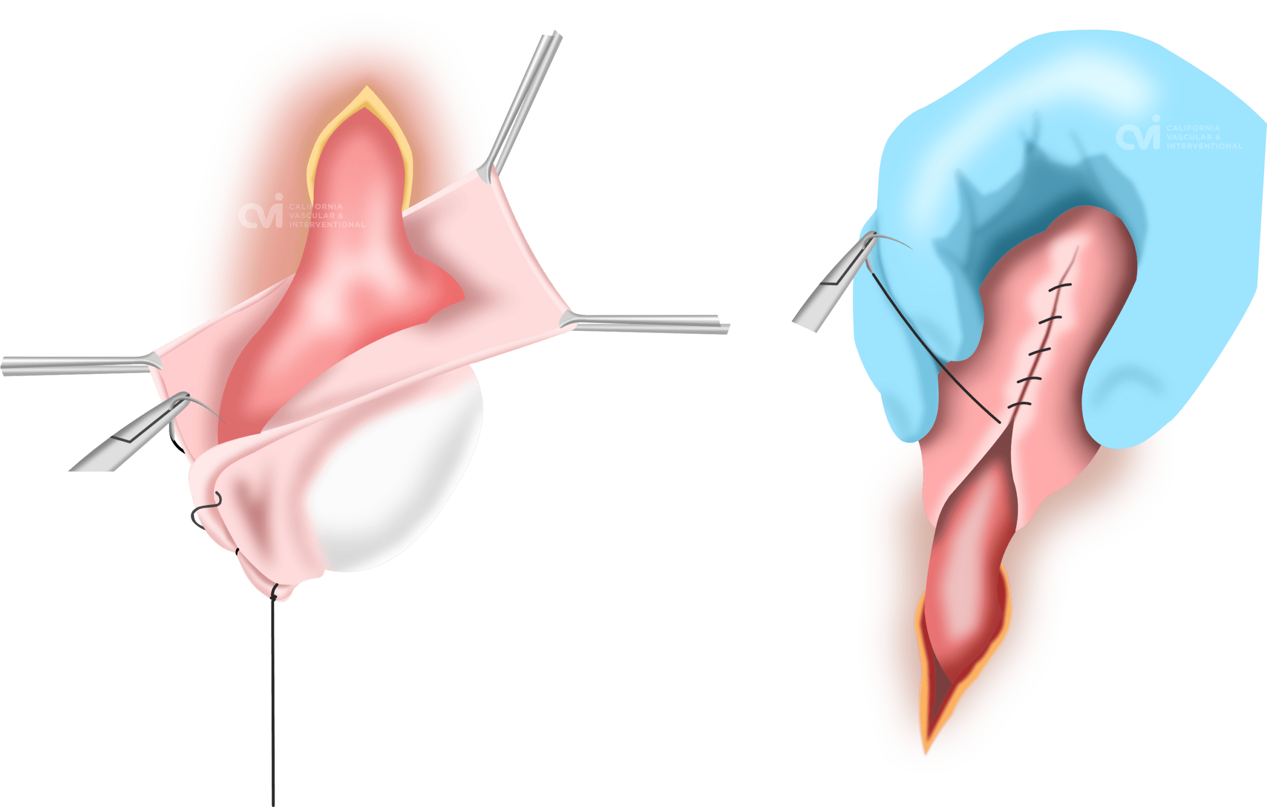 Scrotal Hydrocele Sclerotherapy stitch