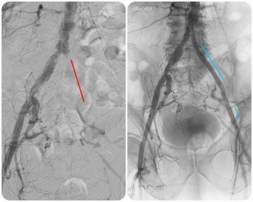 Peripheral Arterial Disease Treatment