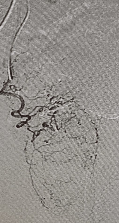 Enlarged Prostate internal image