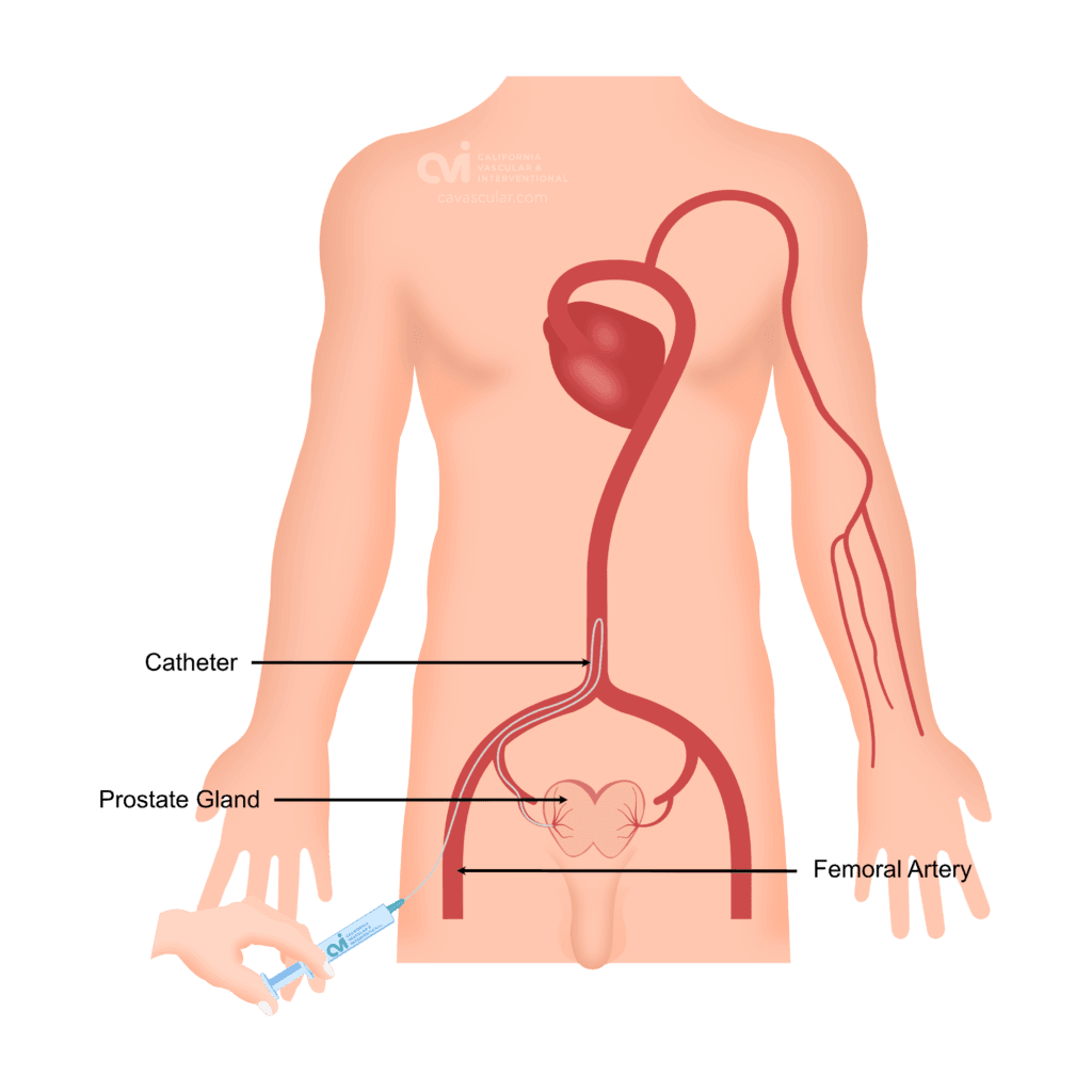 PAE-femoral