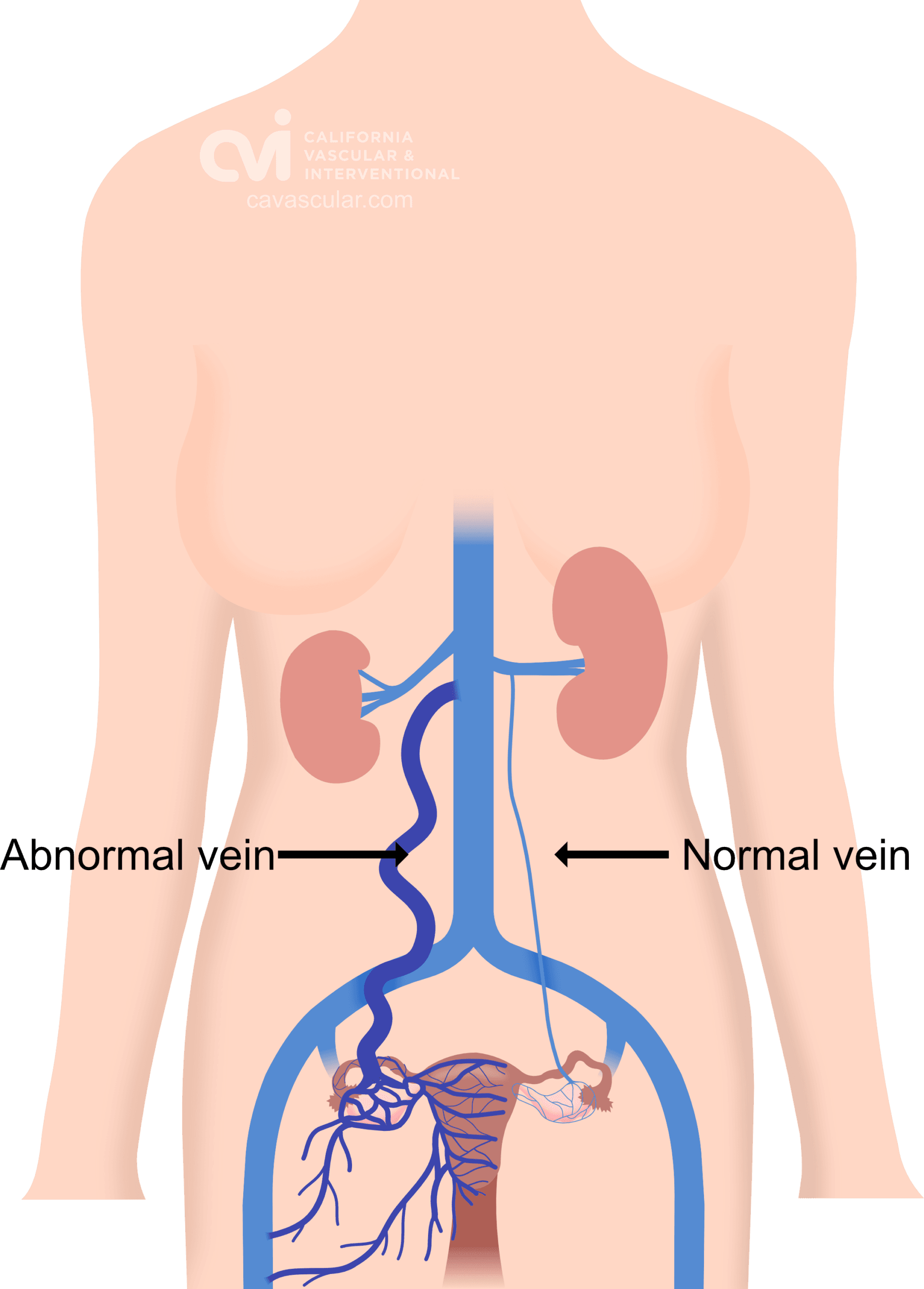 PCS Right abnormal vein illustration scaled