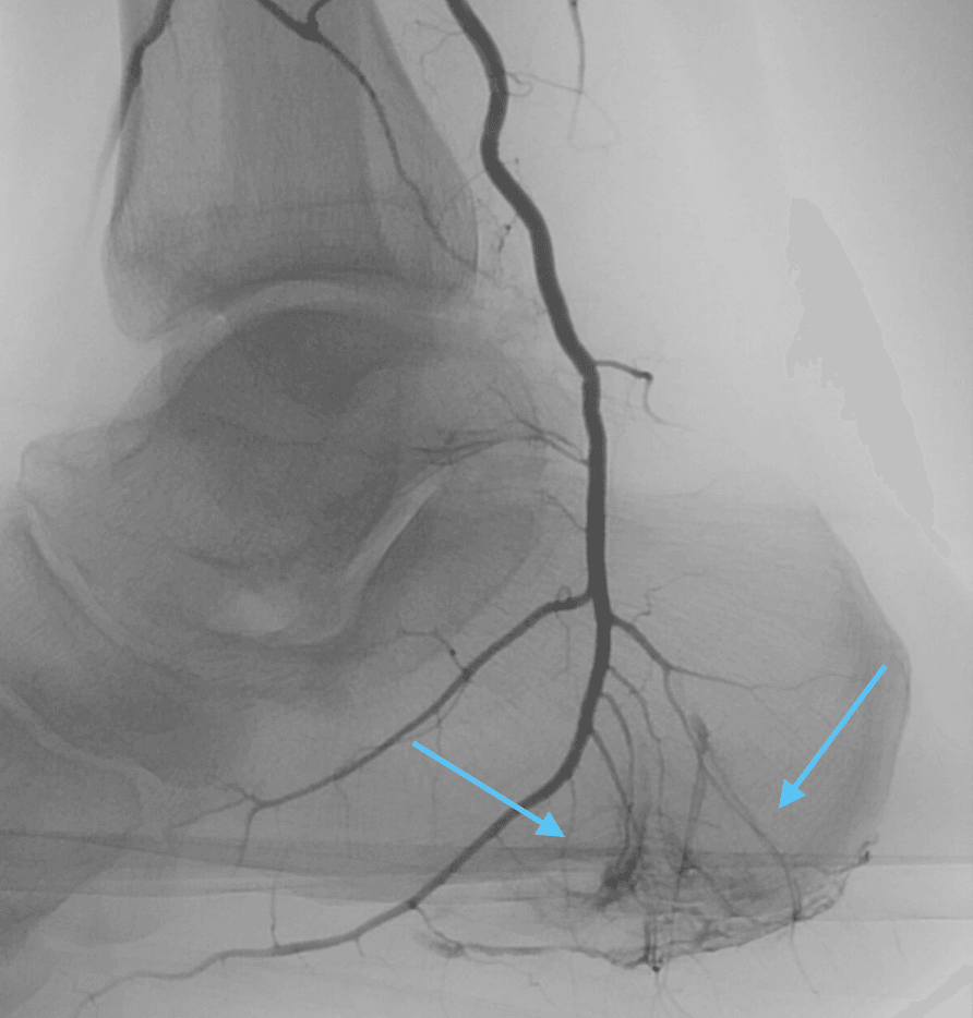 Plantar Fasciitis Angiogram 2b