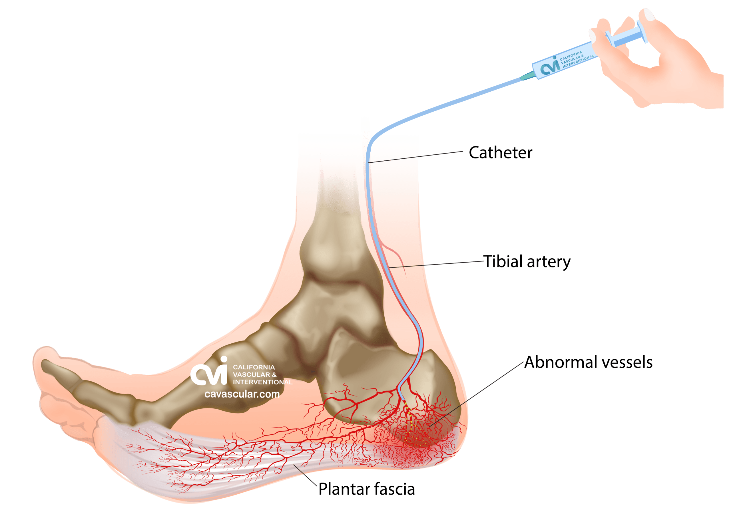 Plantar Fasciitis Embolization Treatment illustration 1 scaled
