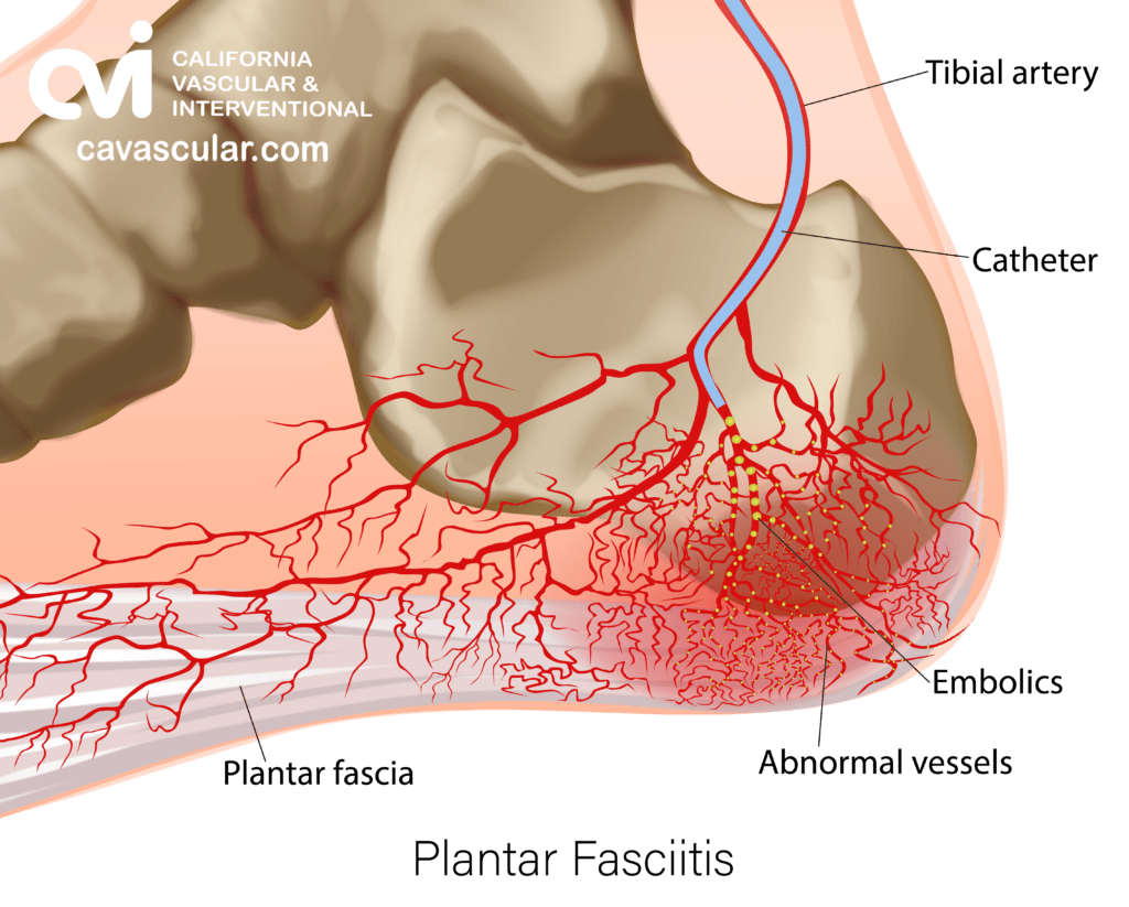 Plantar Fasciitis illustration vascular treatment 2a