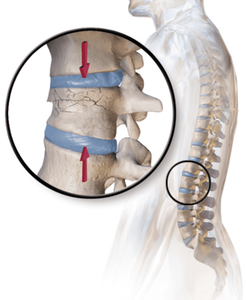 Spinal Compression Fracture Image Diagram
