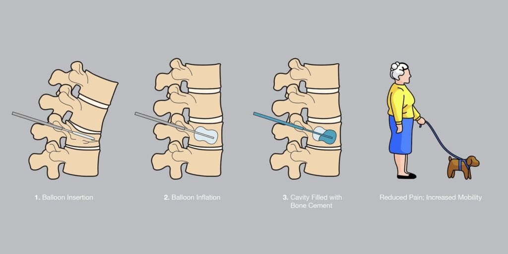 Spinal Compression Fracture