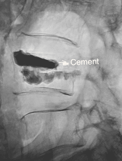 Spinal Compression Fracture cement in x-ray
