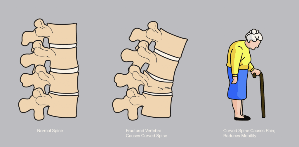 Spinal Compression Fracture image