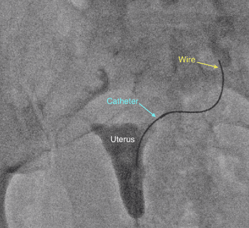 Fallopian Tube Recanalization catheter