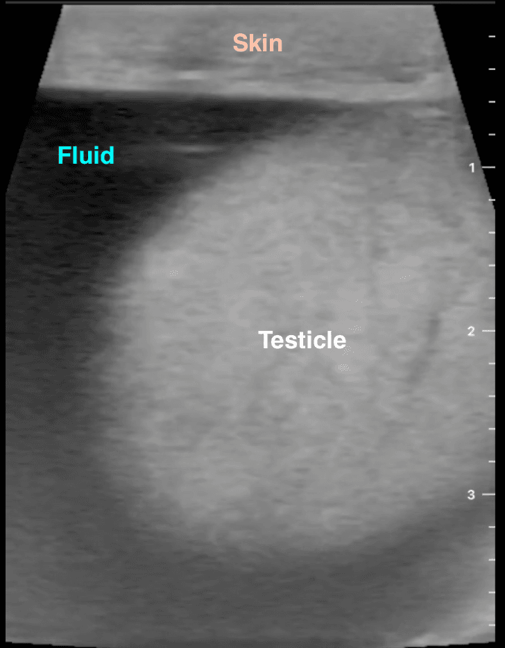 Spermatocele Sclerotherapy ultrasound testicle