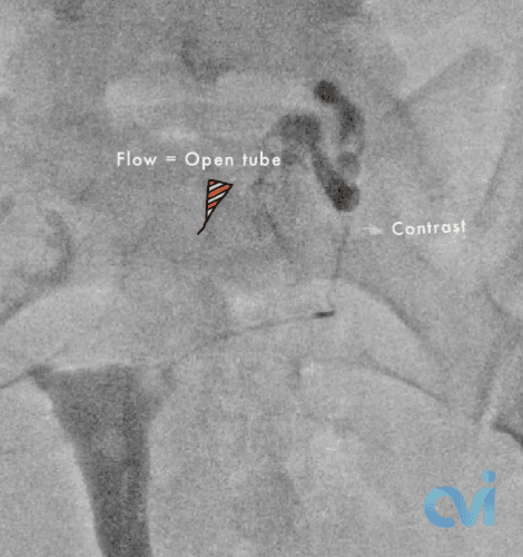 Fallopian Tube Recanalization internal image