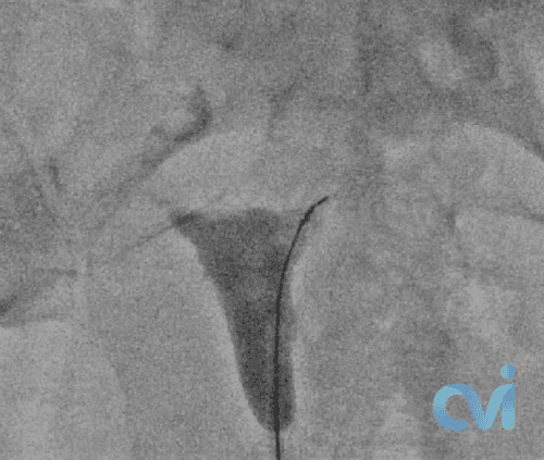 Fallopian Tube Recanalization internal shot