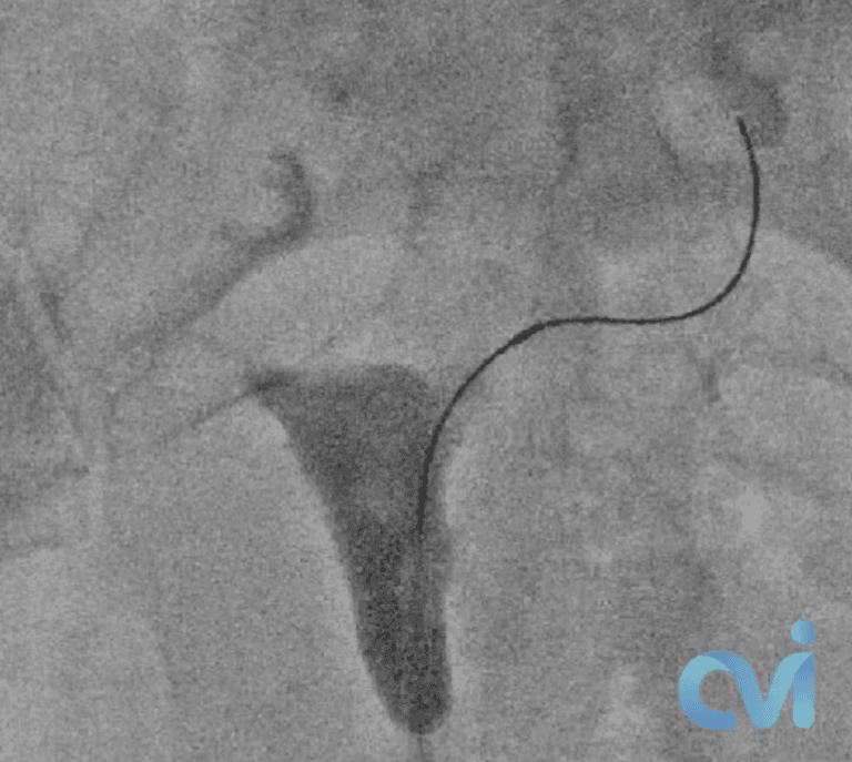Fallopian Tube Recanalization 19 fluoroscopy X-ray image showing fallopian tube recanalization catheter procedure restoring tubal patency Beverly Hills California Vascular