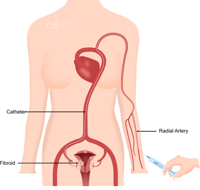 Uterine fibroid embolization los angeles radial artery 1024x973 1