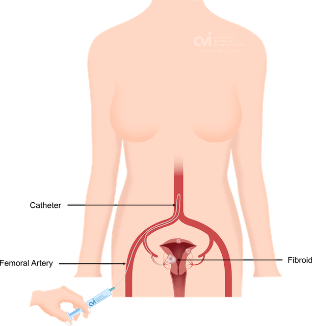 Uterine fibroid embolization specialist los angeles femoral artery 1
