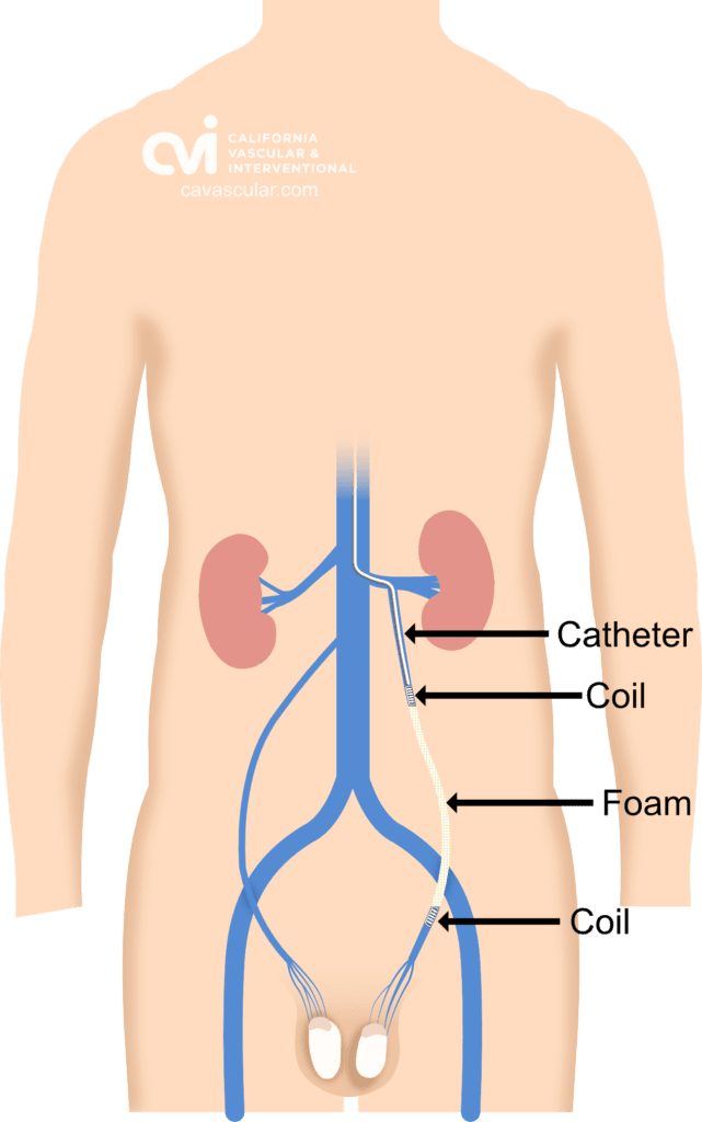 Varicocele-after-embolization