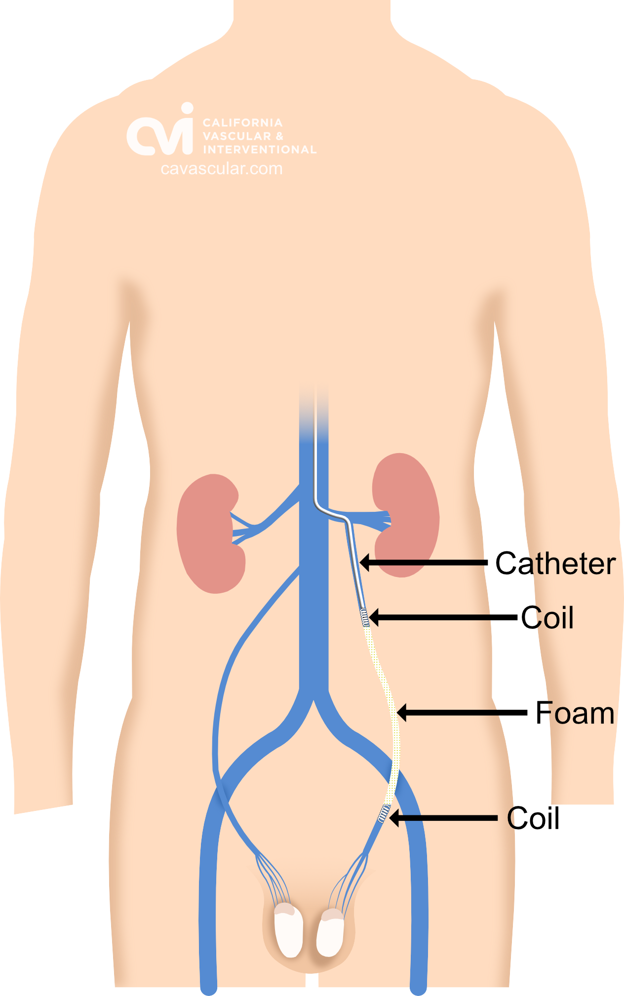 Angiogram showing varicocele veins closed after embolization