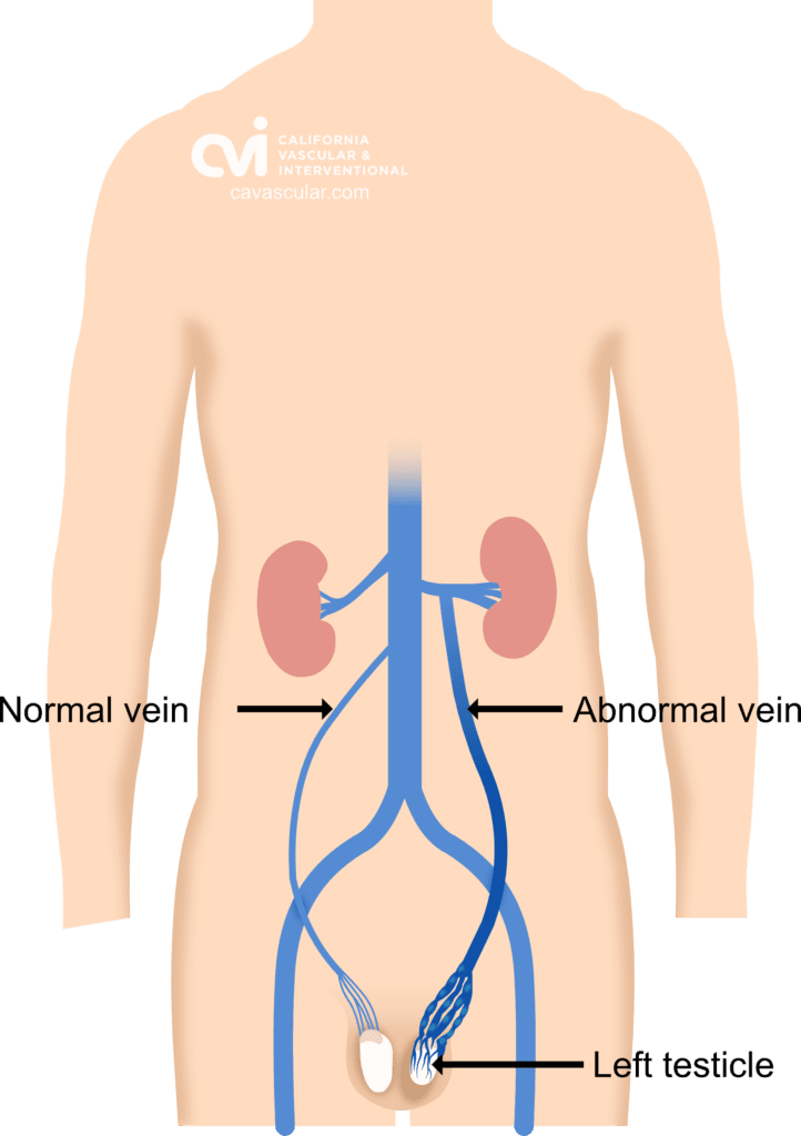 Varicocele before embolization-