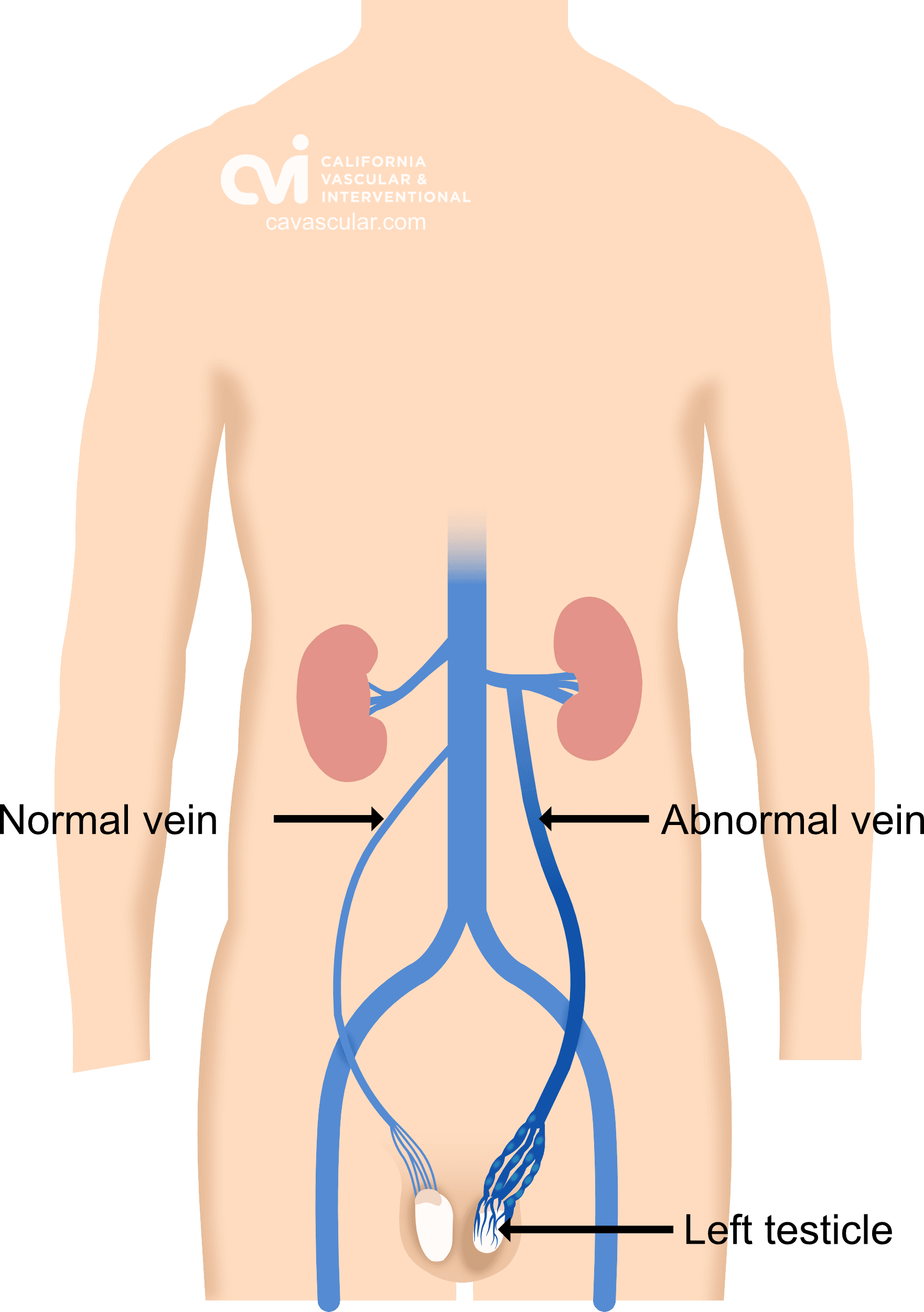 Angiogram showing varicocele veins before embolization
