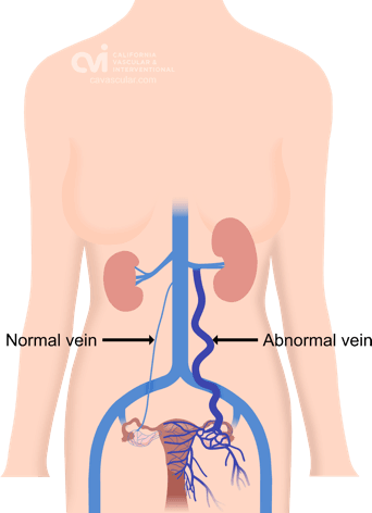Pelvic Congestion Impact on Fertility