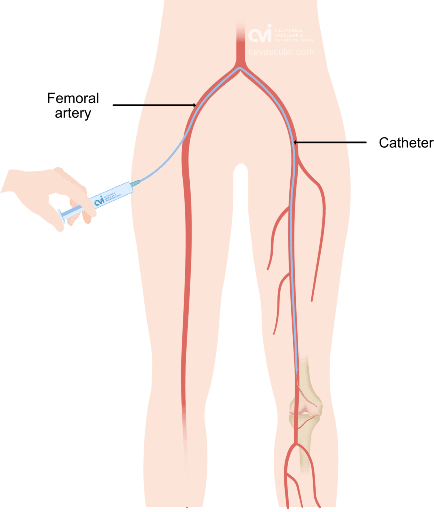 hemarthrosis-catheter