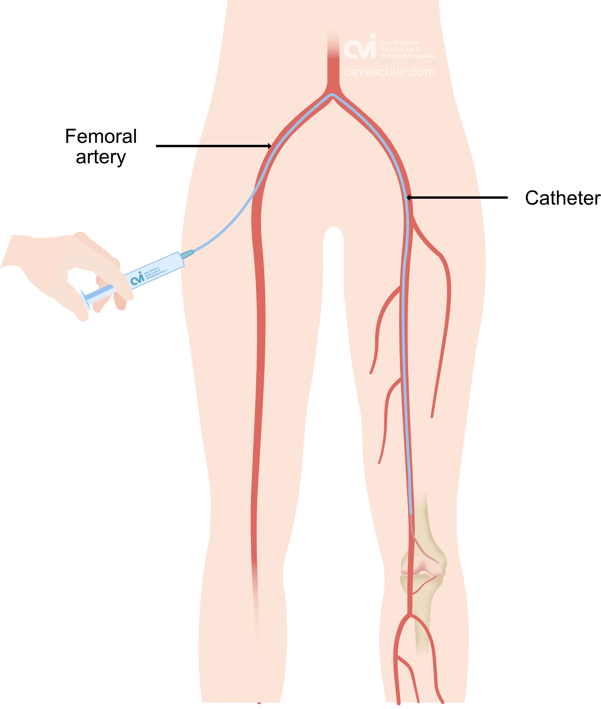 hemarthrosis-catheter