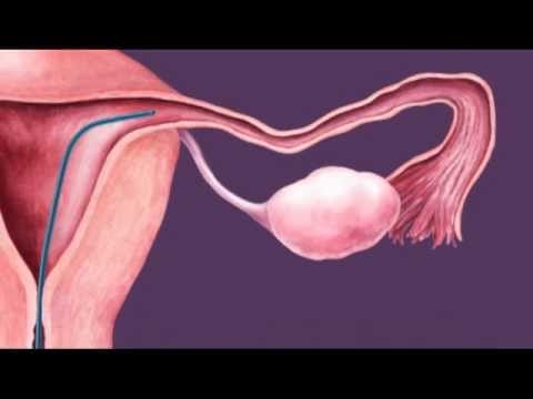 Fallopian Tube Flushing