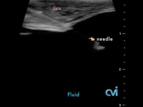 Spermatocele Sclerotherapy ultrasound