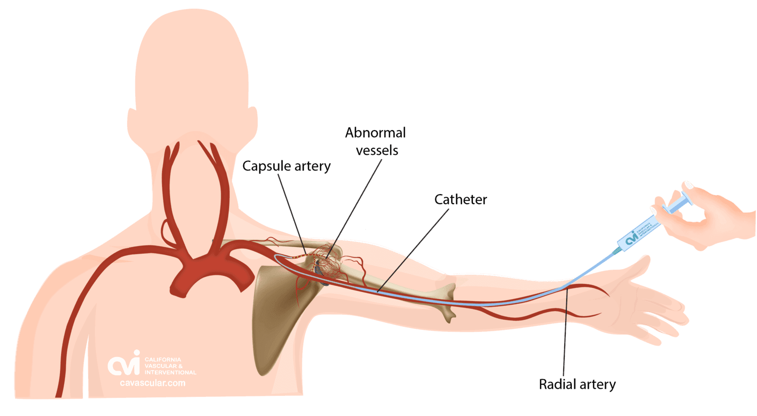 Frozen Shoulder Best Treatment: Embolization vs Surgery