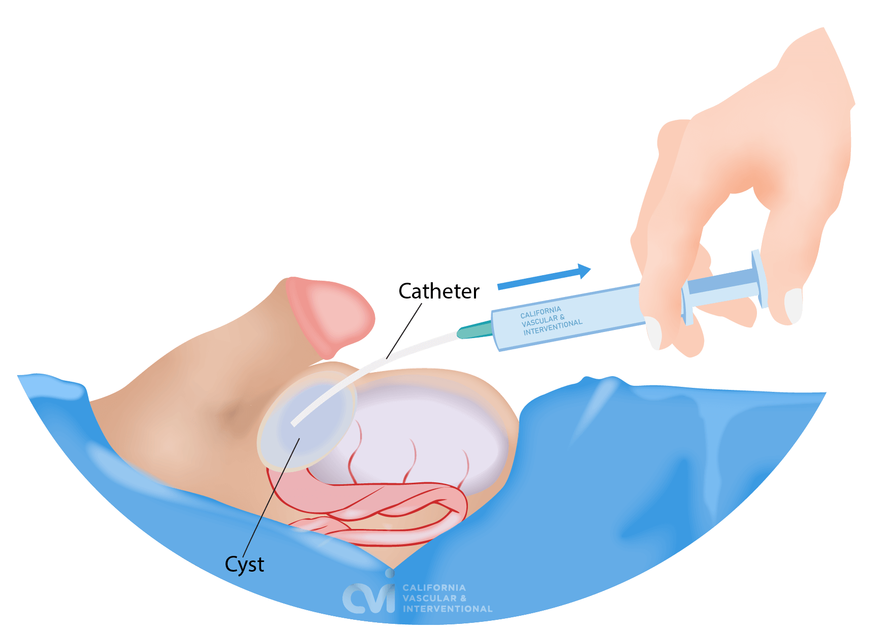 spermatocele aspiration and sclerotherapy procedure step performed in office Beverly Hills California Vascular