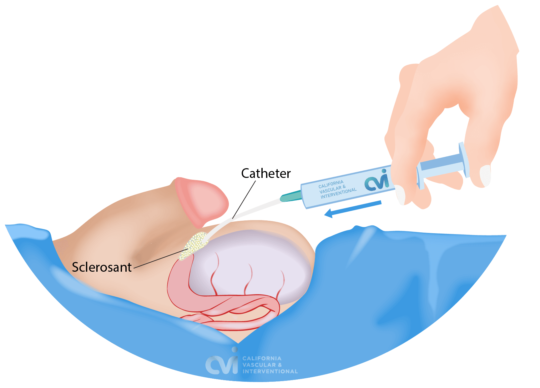 Spermatocele Sclerotherapy