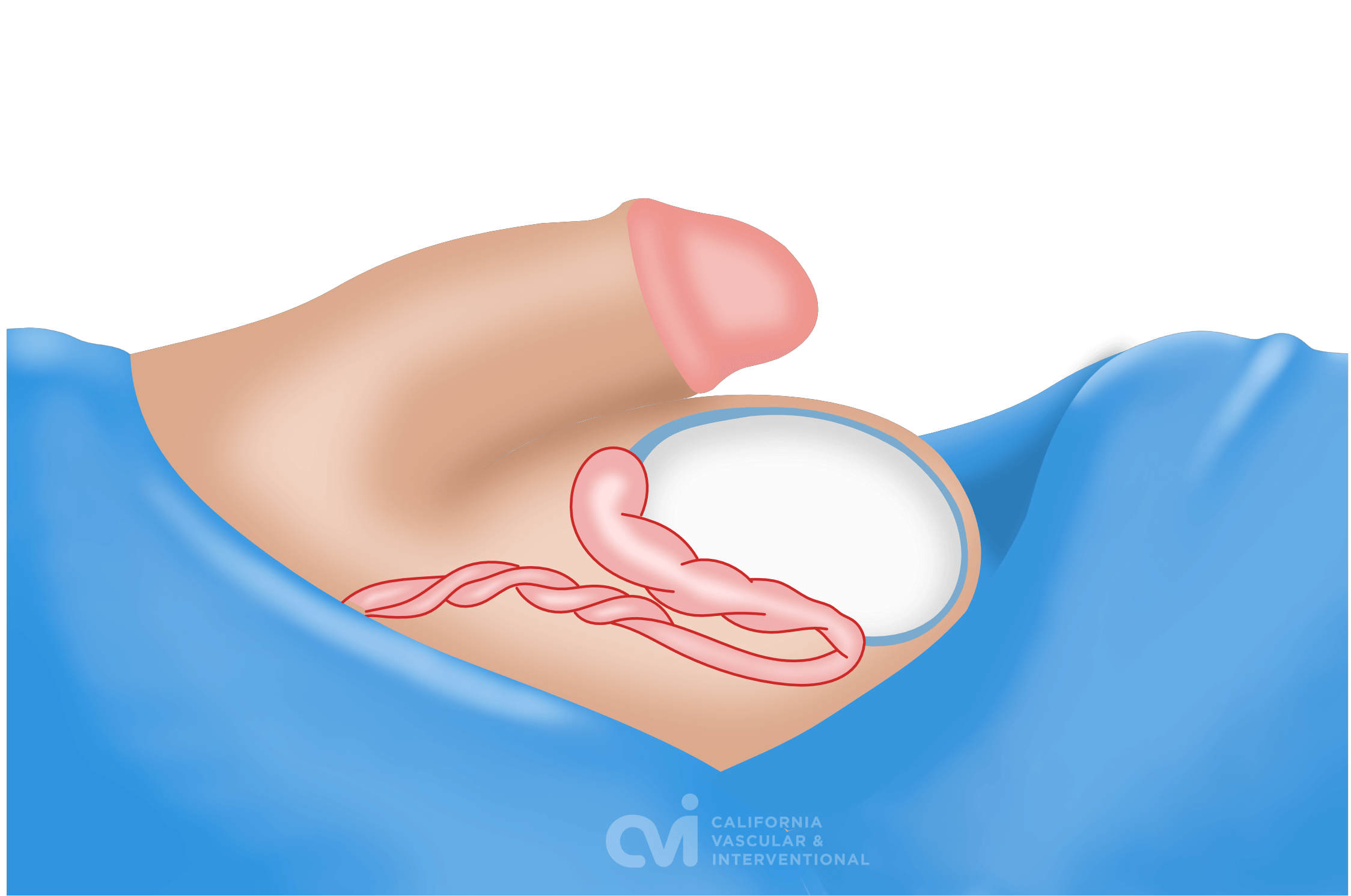 spermatocele sclerotherapy outcome diagram showing non-surgical alternative to spermatocelectomy Beverly Hills