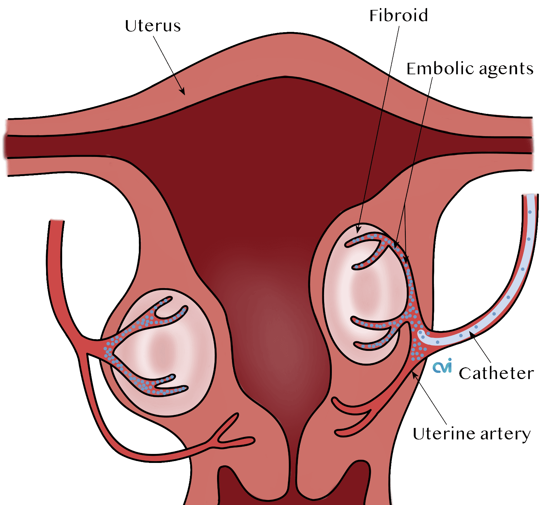 los angeles fibroid specialist