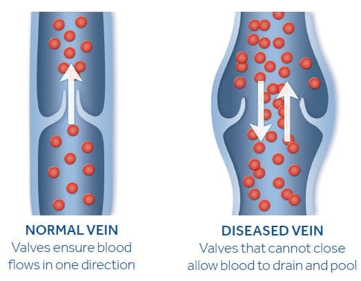 normal-vs-diseased-vein