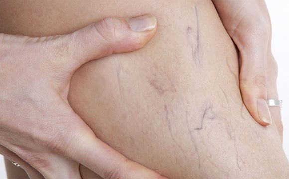 spider-vein-treatment