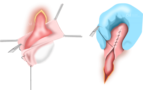 surgical hydrocelectomy