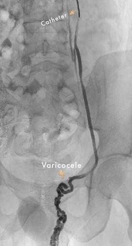 varicocele catherter