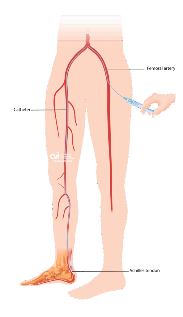 Achilles Tendinopathy Embolization