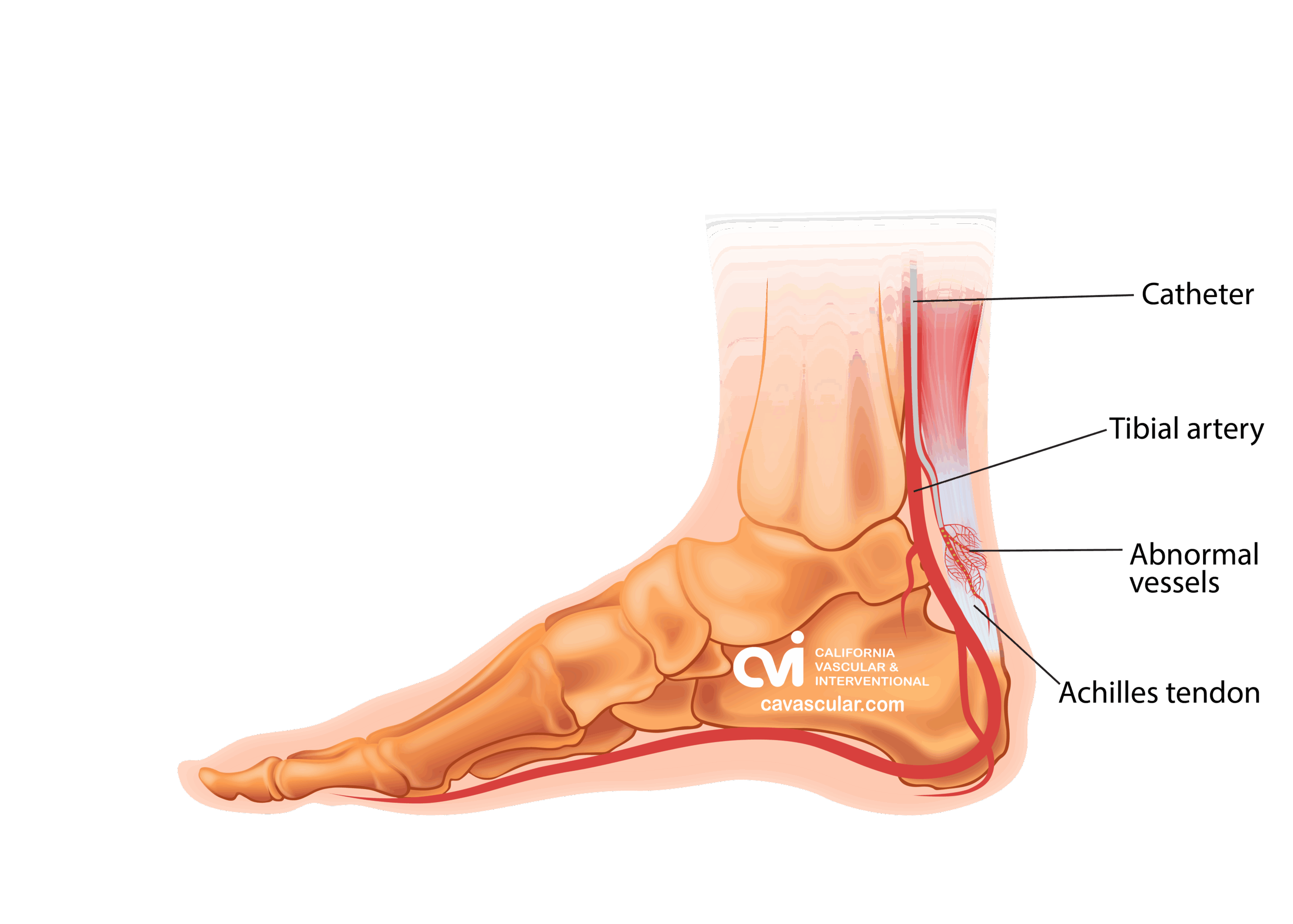 Achilles Tendinopathy Embolization leg