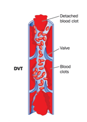 Deep Venous Thrombosis (DVT) internal diagram