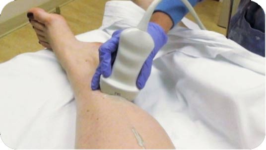 Deep Venous Thrombosis (DVT) treat ment