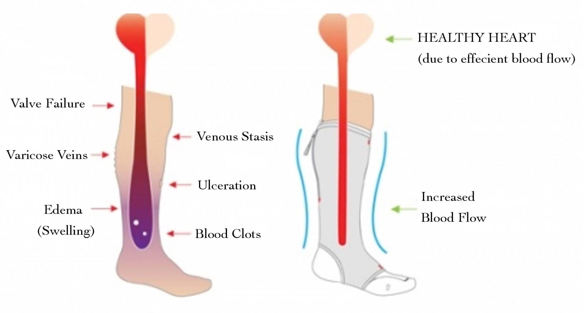 Deep Venous Thrombosis (DVT)