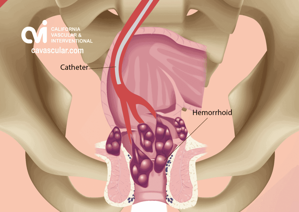 Hemorrhoid Artery Embolization (HAE): Recovery